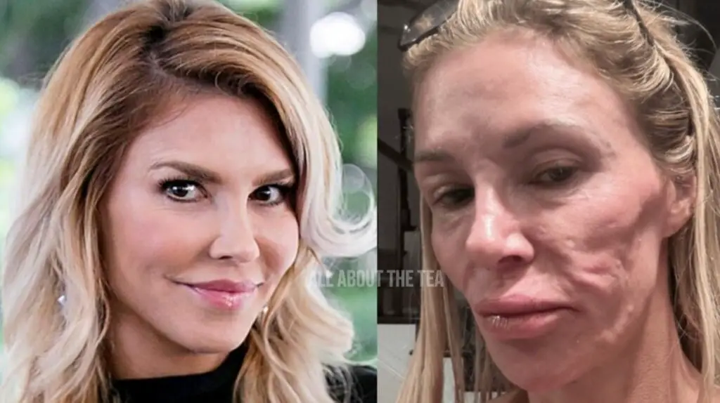 Brandi Glanville falls into ‘deep depression’ due to terrible facial disfigurement!