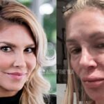 Brandi Glanville falls into ‘deep depression’ due to terrible facial disfigurement!